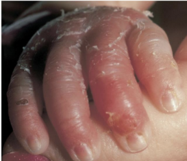 <p><span><span>Staphylococcus aureus infection</span></span></p><p>Caused by exfoliative toxins A and B; skin peels off in sheets, mainly in newborns and infants.</p>