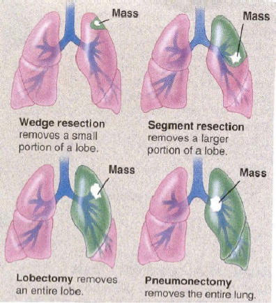 <p>removes a small portion of a lobe</p>