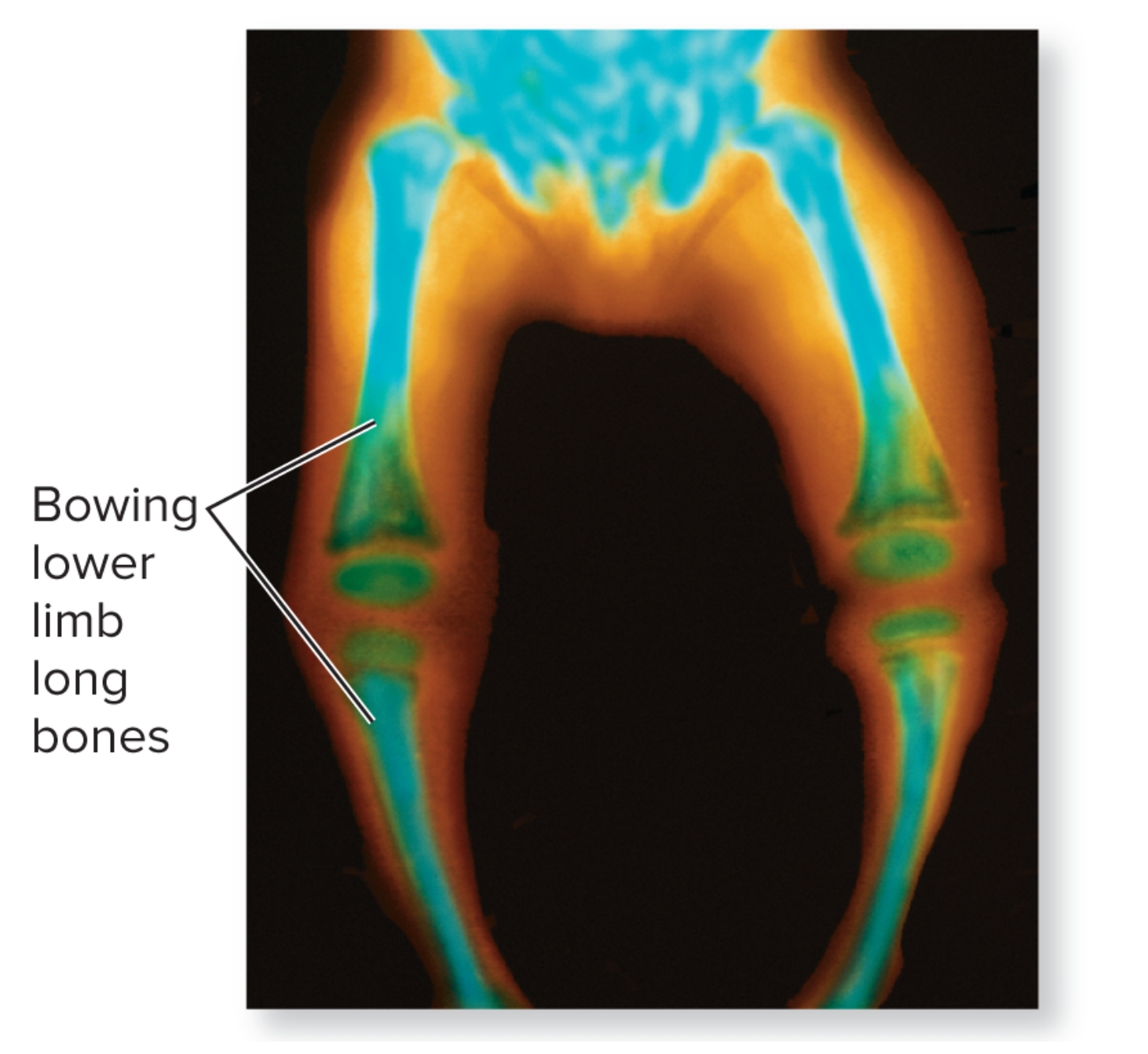 <p>What is rickets?</p>