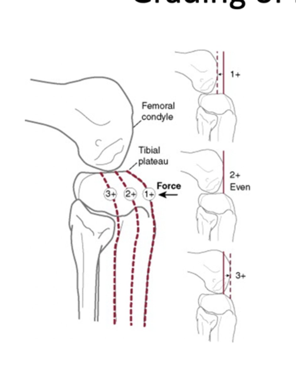 <p>1+: Tibia plateau is slightly posterior to femoral condyles</p><p>2+: Tibia plateau is even with femoral condyles</p><p>3+: Tibia plateau is posterior to femoral condyles</p>