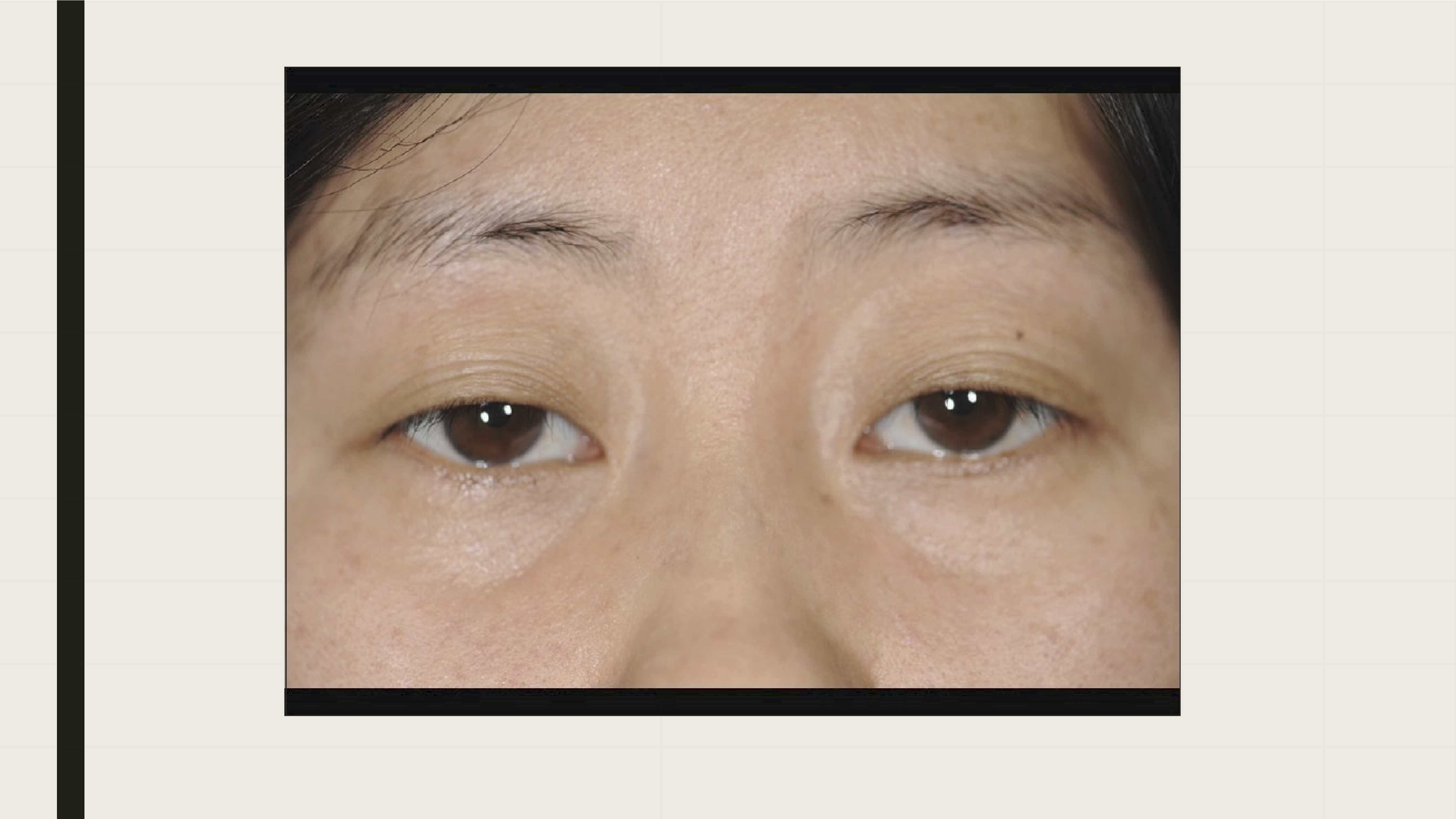 <p>Genetic condition (autosomal dominant) disorder characterized by increased muscle contraction and slow muscle relaxation, muscle weakness and muscle atrophy. </p>