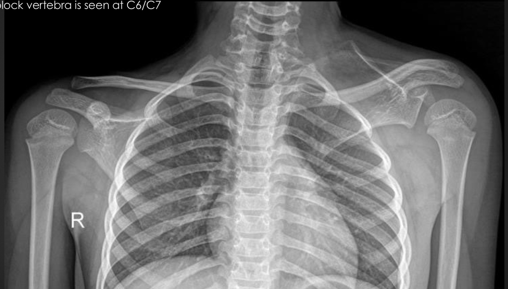 <p>what is this anomaly called </p><p>what syndrome is it often associated with when other factors are present </p>