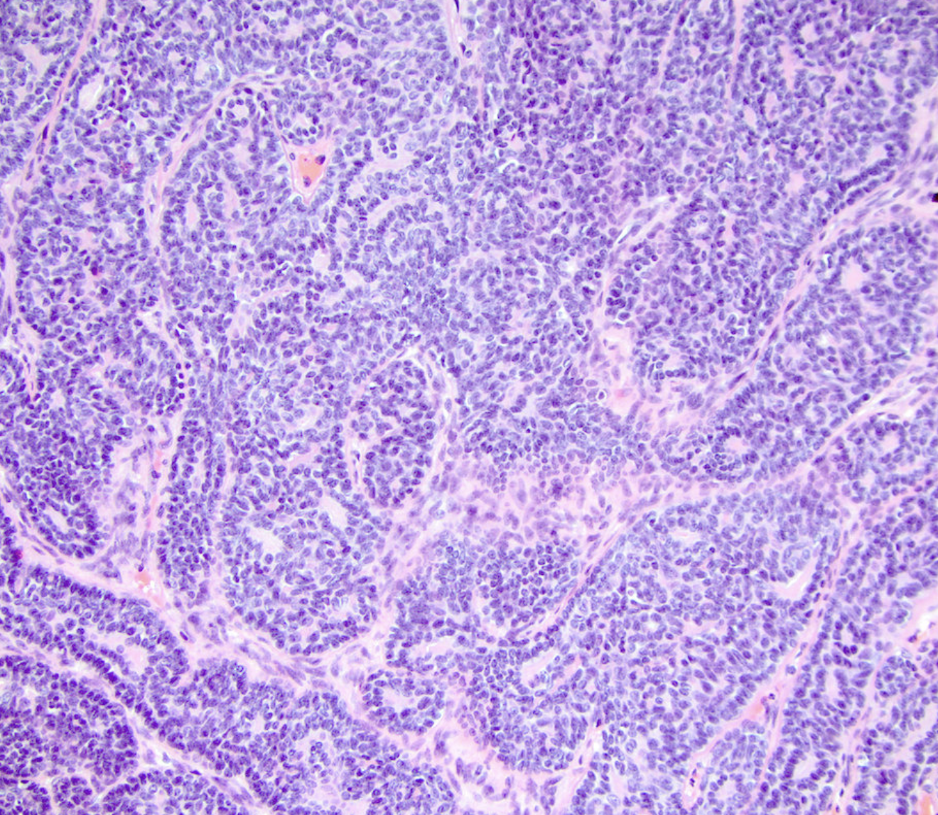 <p>Homme 60 as gonflement parotide </p><p>1) Diagnostic</p><p>2) Clinique (âge, localisation) </p><p>3) Types histologiques et type de pattern principal, nombre de cellules </p><p>4) IHC</p><p>5) Moléculaire </p><p>6 ) DD </p>
