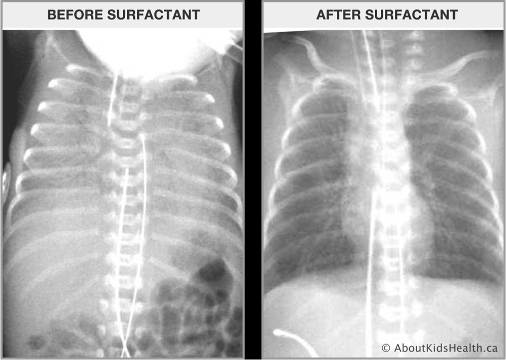 <p>What does this refer to</p><ul><li><p>Treatment</p><ul><li><p>Give Surfactant (endotracheal tube)</p></li><li><p>CPAP</p></li></ul></li><li><p>Prevention</p><ul><li><p>Prevent Pre-term births</p></li><li><p>Corticosteroids given 24 and 34 weeks (help mature lungs)</p></li></ul></li></ul><p></p>