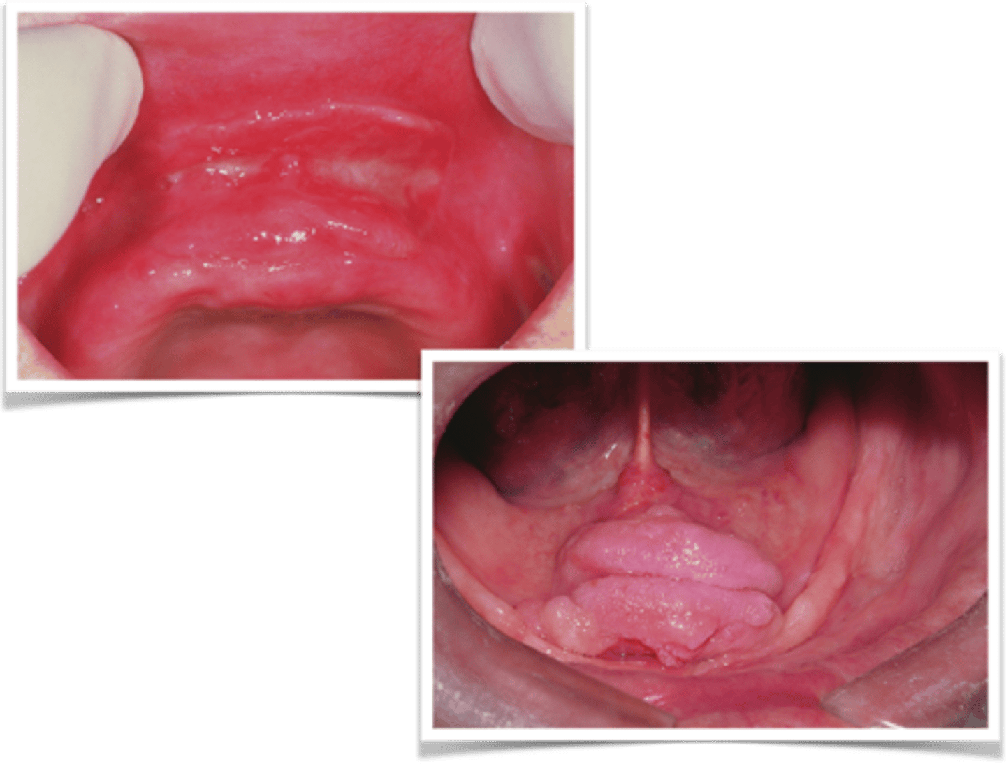 <p>inflammatory fibrous hyperplasia</p>