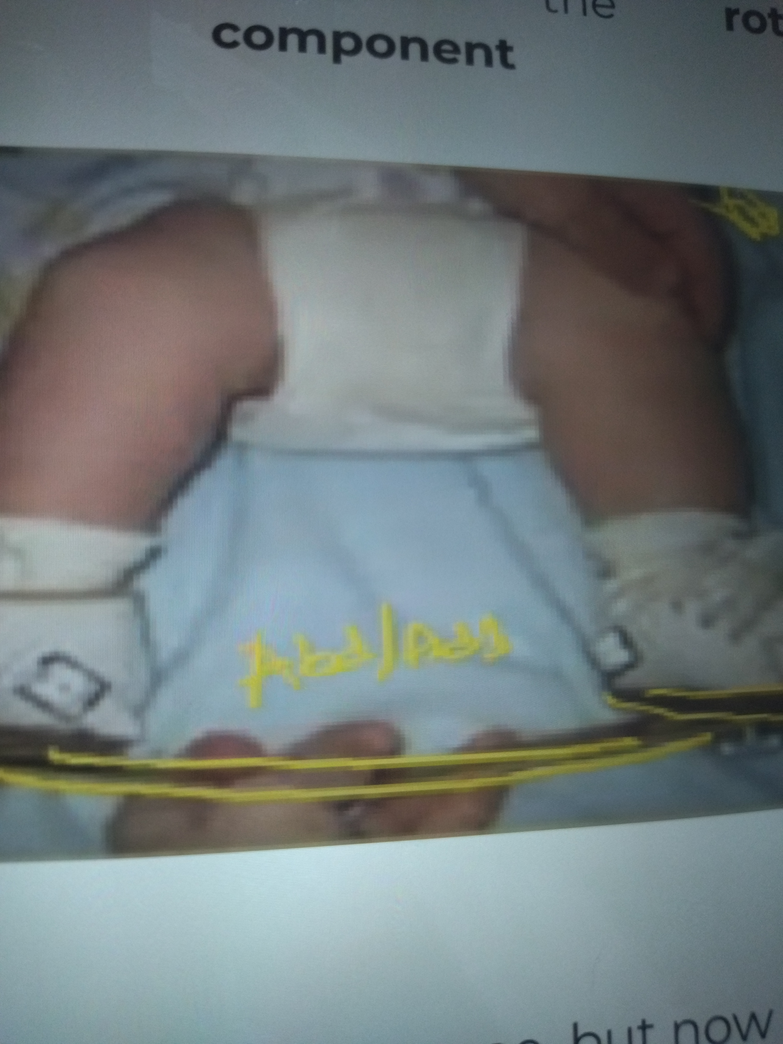 * Used for patients with clubbed foot, hyperpronated foot, abnormal tibial torsion
* Common in toddlers