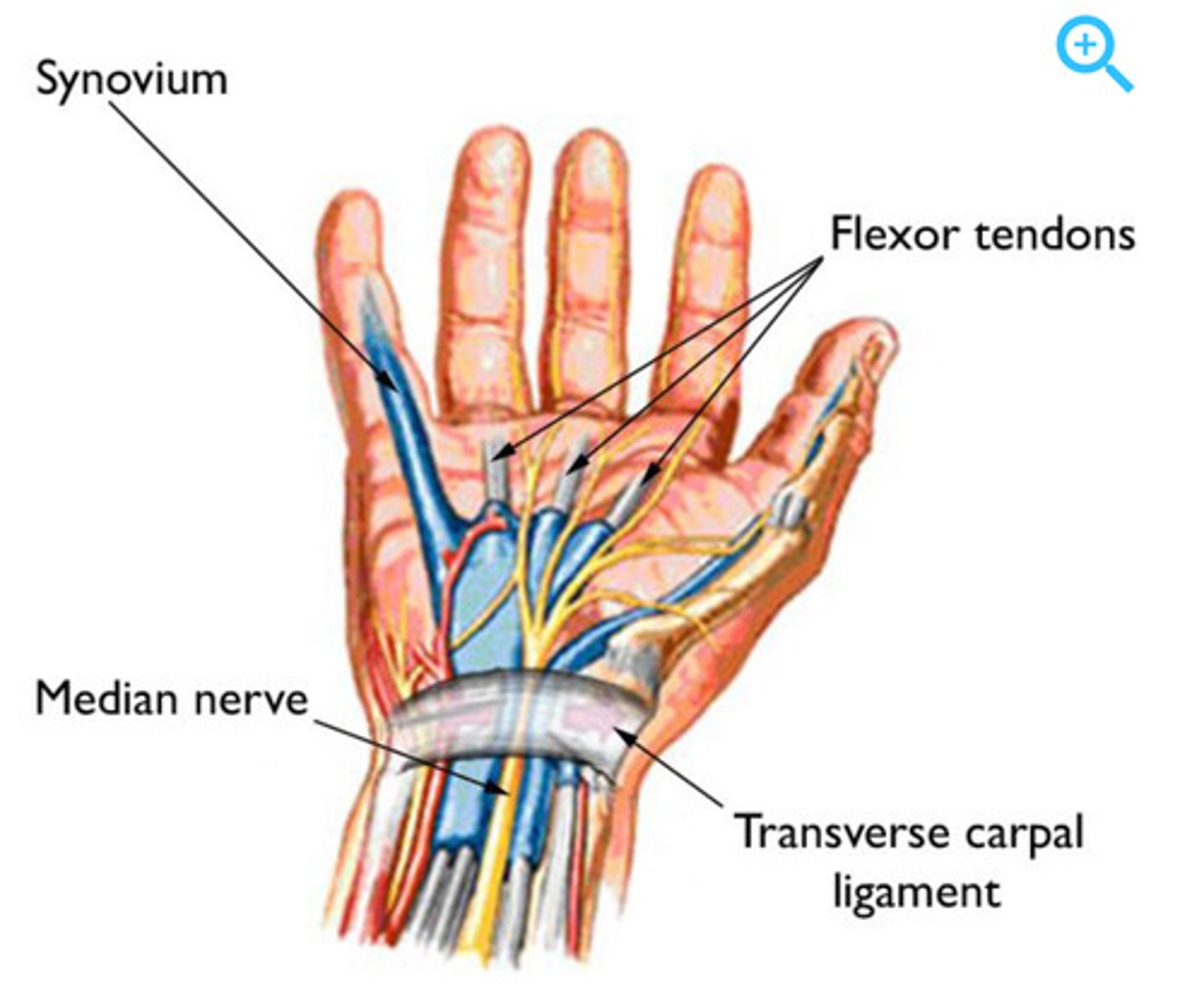 <p>compression of the median nerve as it passes between the ligament and the bones and tendons of the wrist</p>