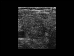 what thyroid pathology is shown here?

symptoms vary but may include mild-severe swelling, tenderness of the thyroid, symptoms of hypothyroidism