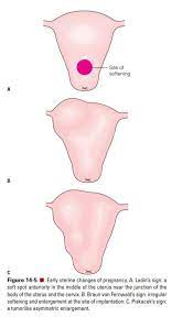 <p>irregular globular shape (softening and enlargement at the site of implantation)</p><p>image = B</p>