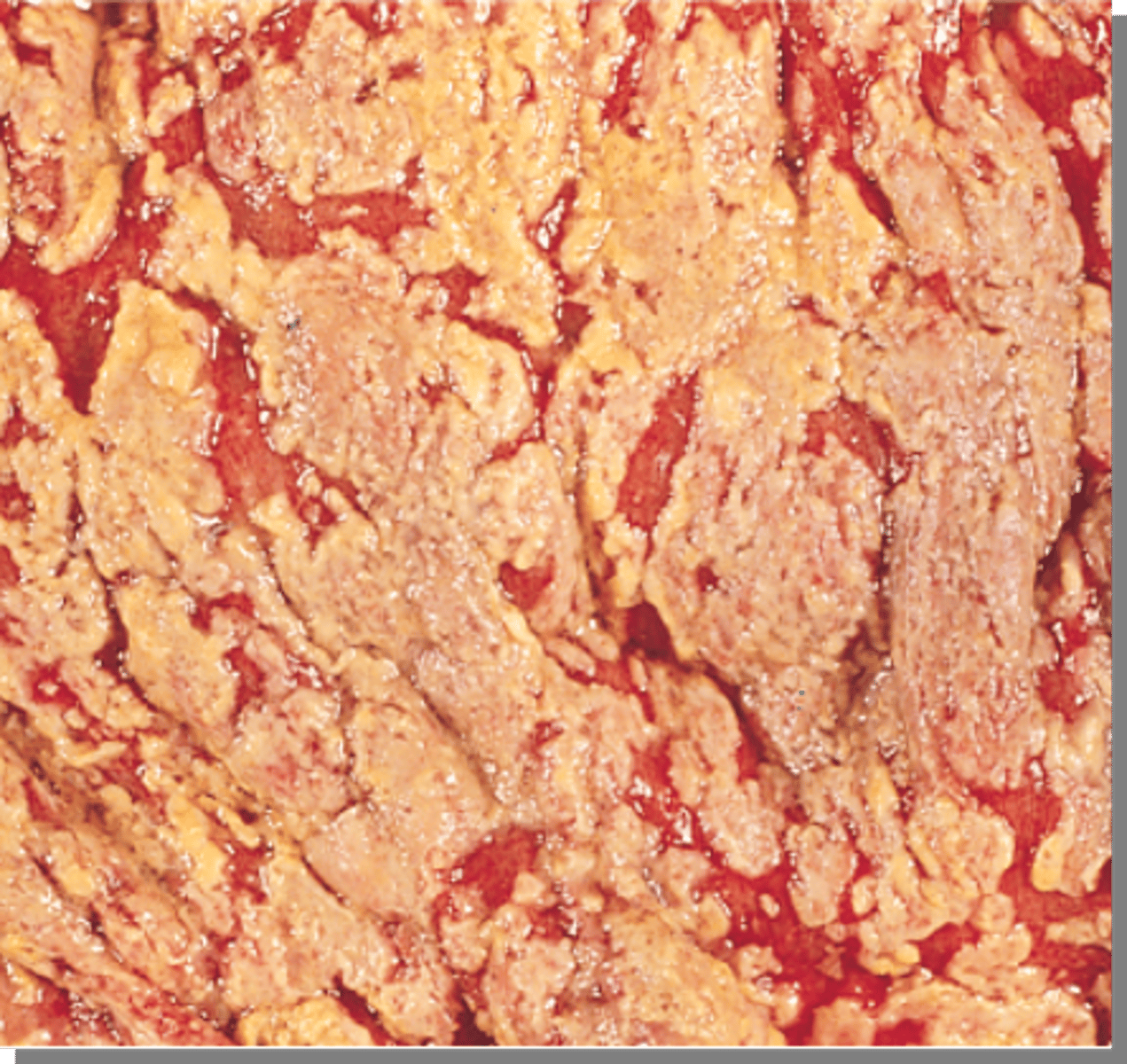 <p>A severe C. diff complication showing yellow-white inflammatory plaques on the colon wall.</p>