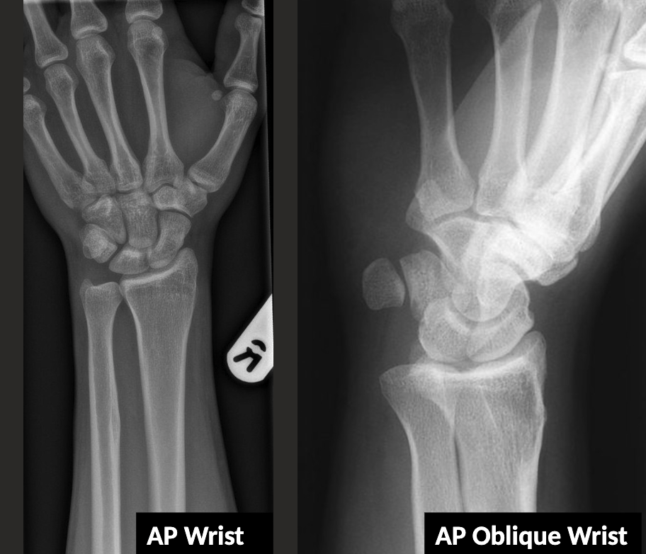 <p>AP Oblique → radial aspect raised 45 degrees from AP.</p>