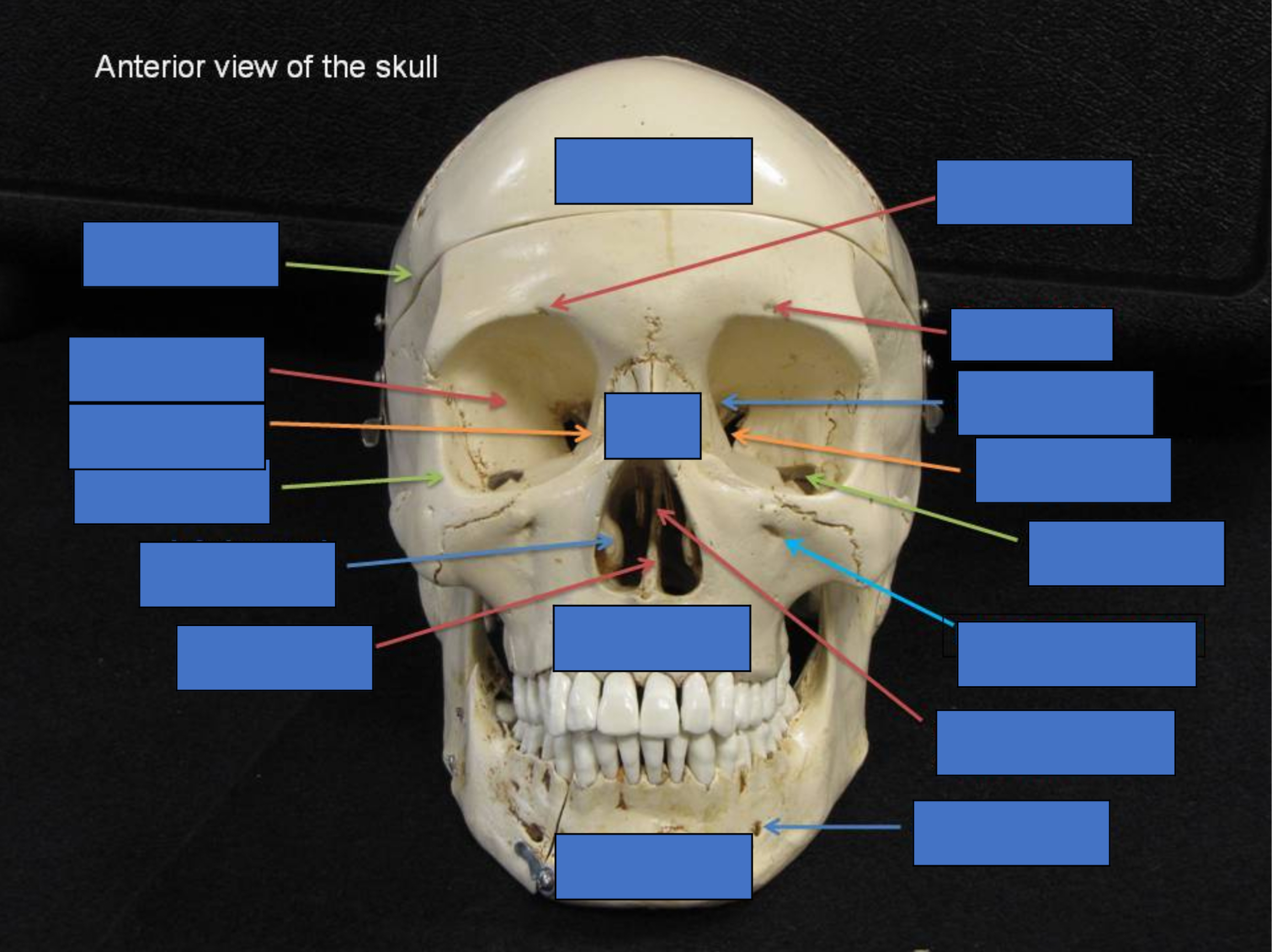 <p>Temporal Bone</p>