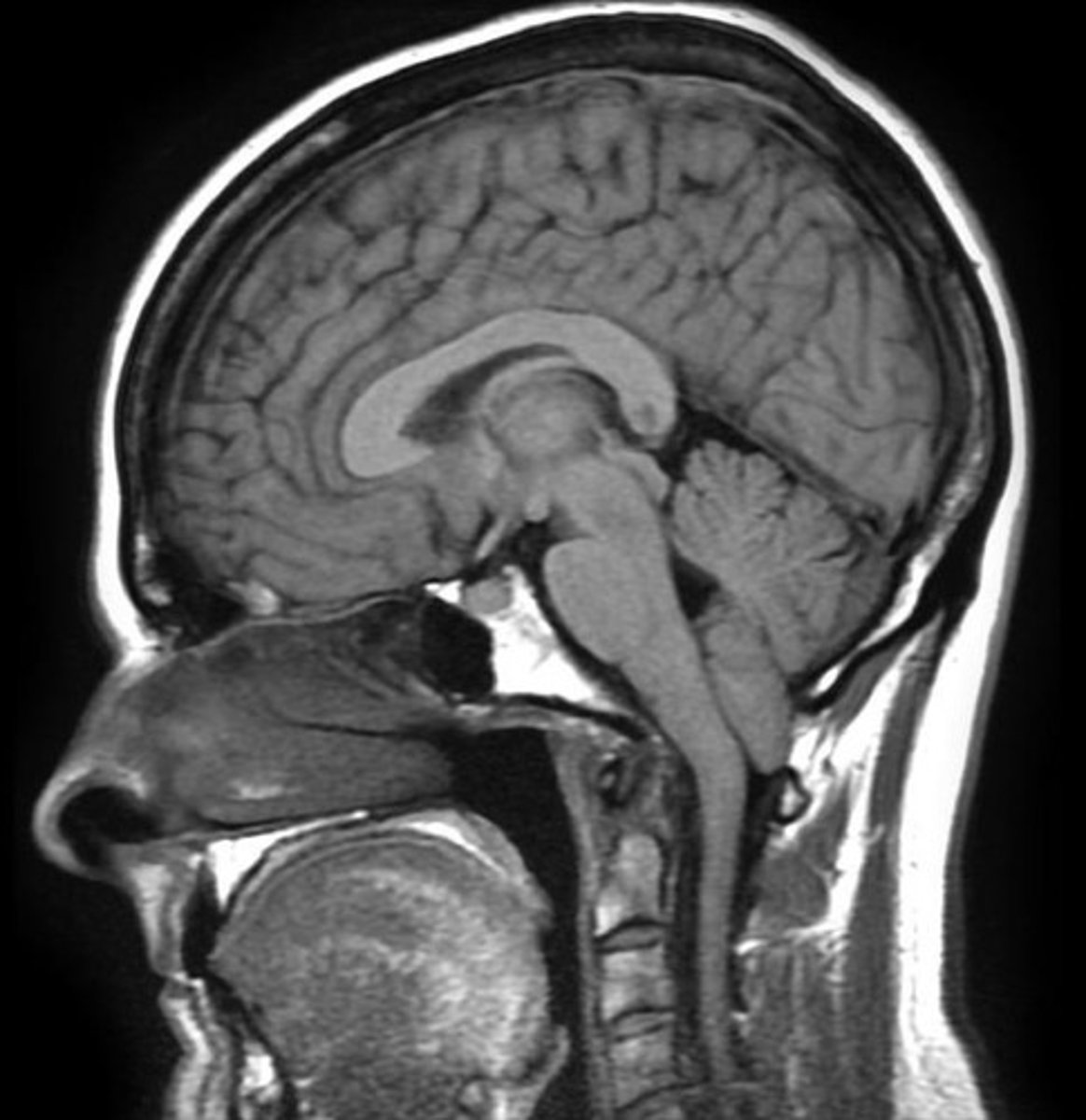<p>not eligible for surgery, herniation of cerebellar vermis (symptoms occur is usually in adulthood), 2/3 of the cases</p>