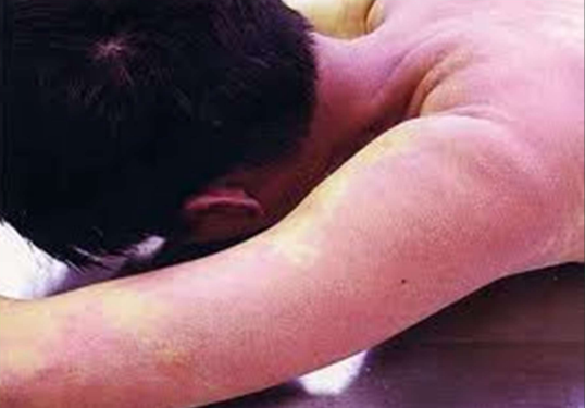 <p>Skin discoloration caused by…</p>