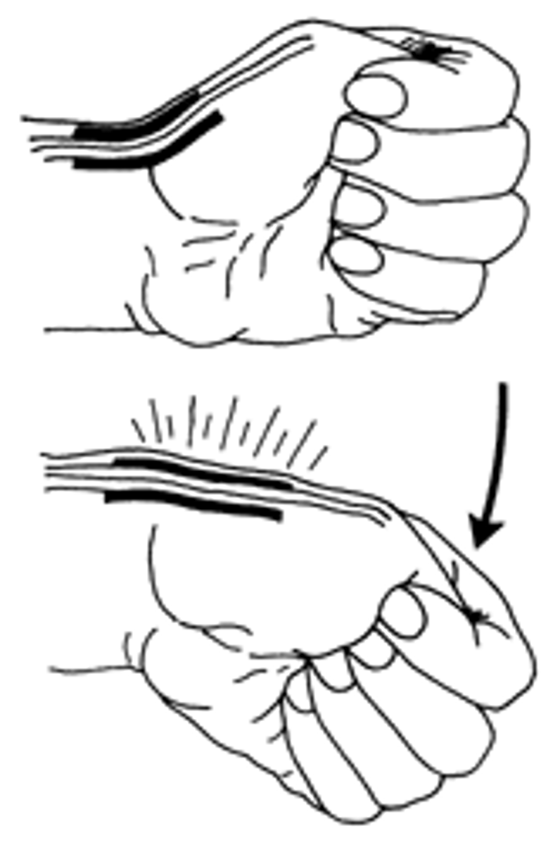 <p>A + Finkelstein's test indicates which of the following?</p><p>a. Radial head fx</p><p>b. De Quervain's tenosynovitis</p><p>c. Dupuytren's contracture</p><p>d. Distal radius fx</p>