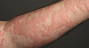 <p>Wheals coalesce to form extension reaction, intensely pruritic (itchy)</p>