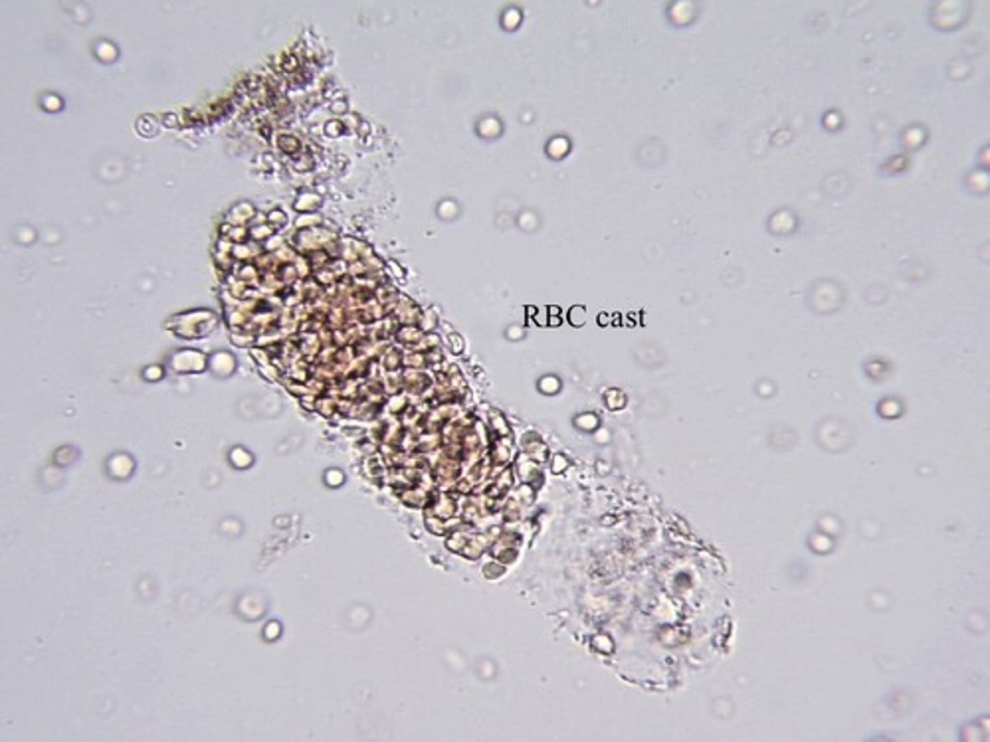 <p>RBC Cast</p><p>-IDs kidneys as a source of bleeding.</p><p>Most fragile cast.</p><p>Often in fragments.</p>
