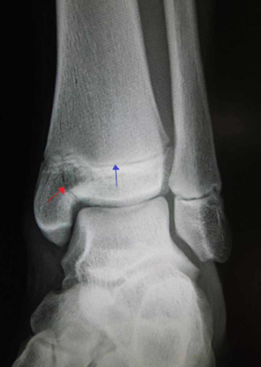 <p>What type of fracture is this?</p>