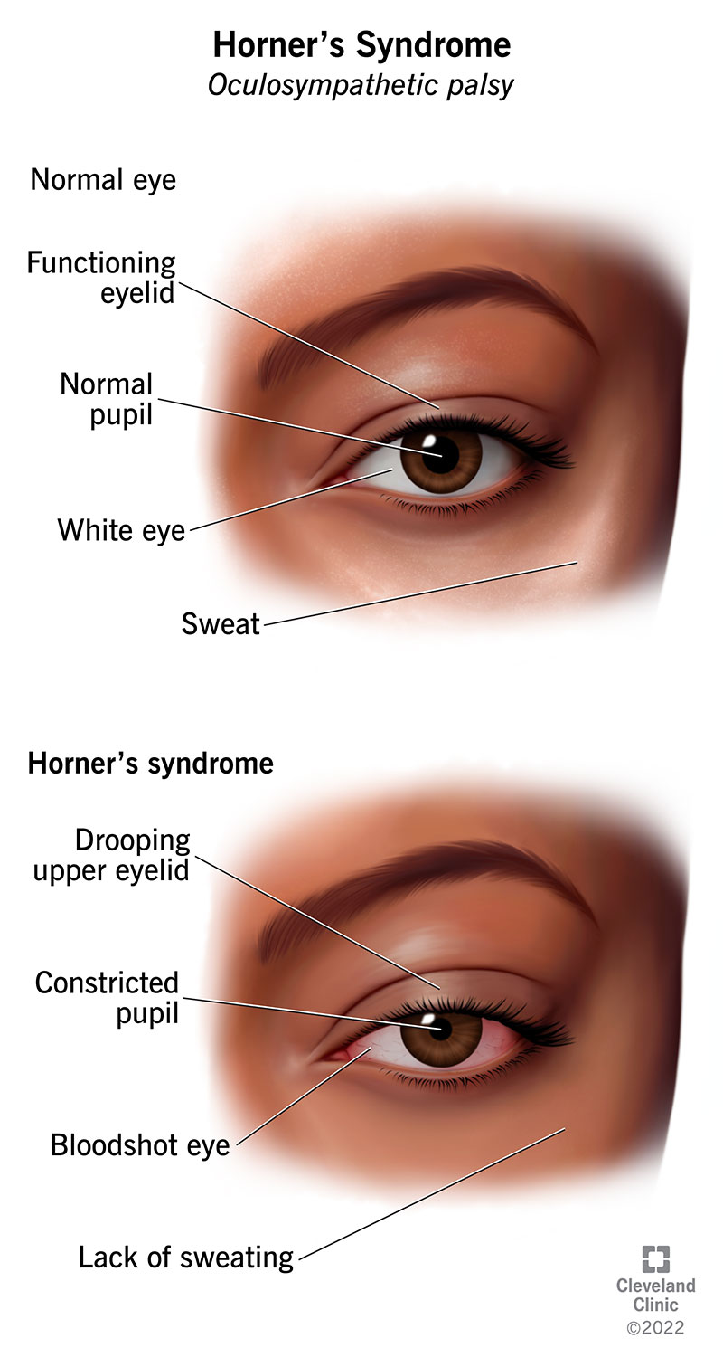 <p>PP: small+unilateral pupil+slowed dilation</p><p>E: congenital (heterochromia)<br>SNS damage<br>ipsilateral brainstem lesions<br>neck+chest tumors affecting ipsilateral sympathetic ganglia<br>orbital trauma<br>migraines</p><p>CM:<br>horner syndrome triad:<br>miosis<br>ptosis<br>anhydrosis</p><p>loss of sweating on forehead</p><p>PE: anisicoria 1+ mm difference<br>ipsilateral ptosis of eyelid</p><p>light reaction→reacts normal+near effort<br>dim light→dilates slowly</p><p>heterochromia→congenital</p>