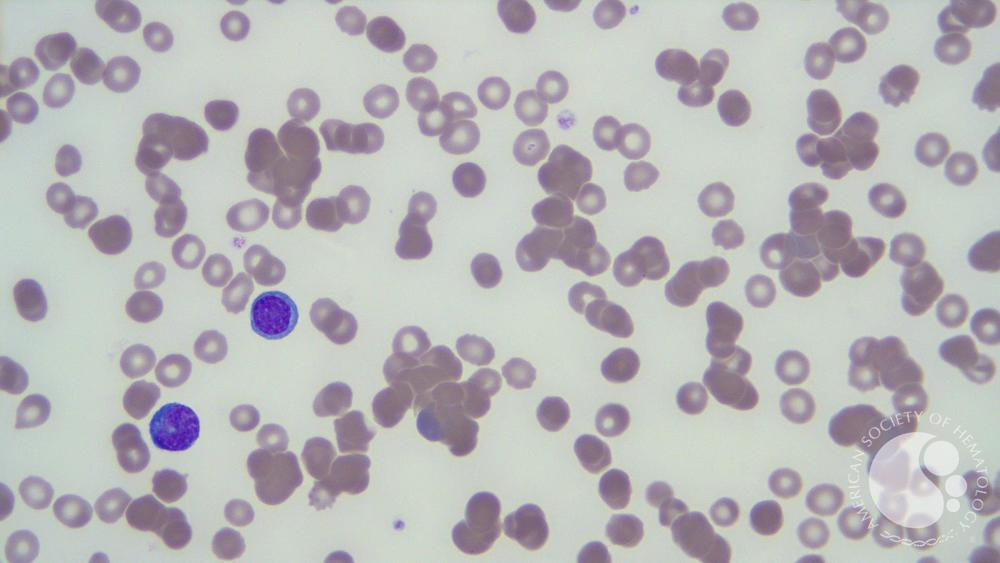 <ul><li><p>RBCs coated w/ IgM and complement at temps BELOW 37C</p></li><li><p>Can be idiopathic or secondary to M. pneumoniae</p></li><li><p><strong>MCHC &gt;37 g/dL</strong></p></li><li><p>Inc. bilirubin &amp; retic count</p></li><li><p>Positive DAT (complement-coated RBCs)</p></li><li><p>Warm sample to 37°C for accurate results if high antibody titer</p></li></ul><p></p>