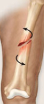 Spiral fracture
