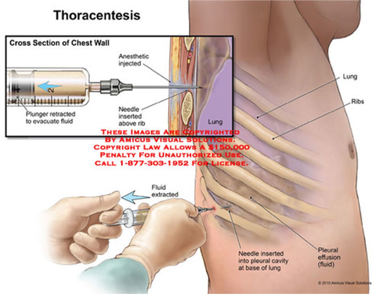 <p>o Anesthetize skin, constantly withdrawing</p><p>o Switch to larger needle, perpendicular, constantly withdrawing until pleural fluid return</p><p>o Insert angiocath with syringe same distance and withdraw fluid</p><p>o Remove needle from catheter and Discard</p><p>o Attach IV tubing (turned off) to angiocath and then vacuum bottle</p><p>o Turn on IV tubing</p><p>o Collect as much fluid as required</p><p>o Remove angiocath, do not reinsert needle</p><p>o Pressure for several minutes</p><p>o Band-Aid or occlusive dressing</p>