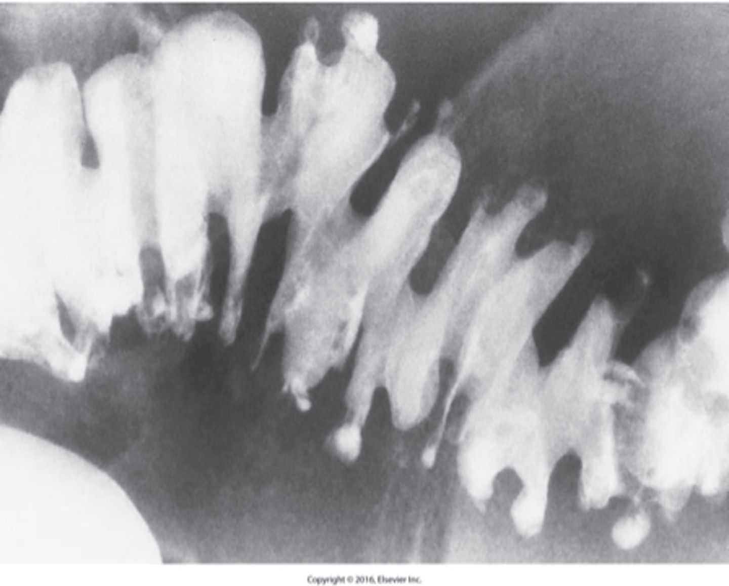 <p>What is diverticulosis "sawtooth"?</p>
