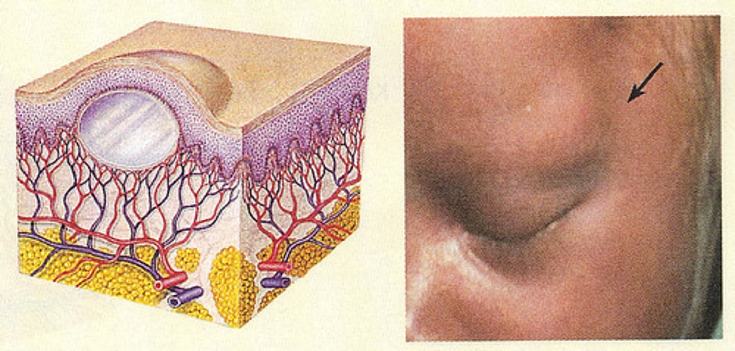 <p>encapsulated fluid filled cavity, dermis or subcutaneous layer, tensely elevated skin</p>