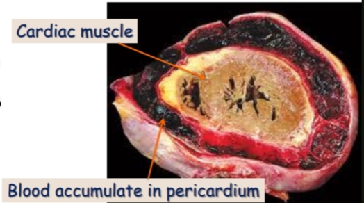 <p>Internal hemorrhage,hemopericardium</p><p>hemothorax , hemoperitonium</p><p>1-Cardiac muscle</p><p>2-Blood accumulate in pericardium</p>