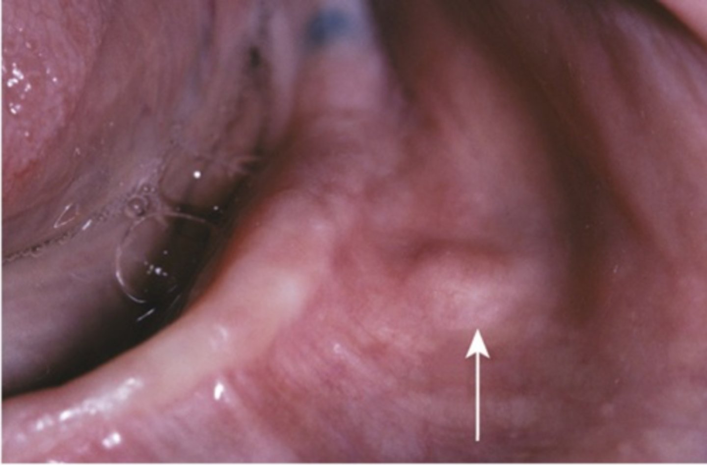 <p>PAINFUL</p><p>• associated with trauma (injections)</p><p>• common location: mental foramen area</p><p>• associated with MEN</p>