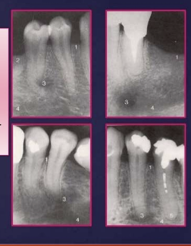 <p>mental foramen </p><p>it appears as radiolucent, ill defined area between the apices of bicuspids - pre-molars</p><p>it represents the anterior terminates of the mandibular canals</p>