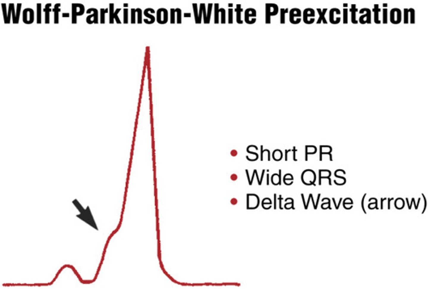 <p>PR interval is shortened &lt; 0.12 seconds</p><p>P wave blends in with QRS (delta wave)</p><p>The QRS is widened secondary to early stimulation of the ventricles</p>