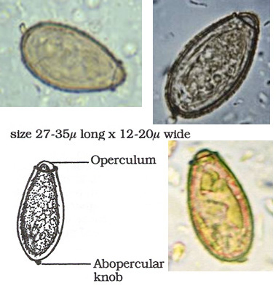 <p>Clonorchiasis</p><p>Helminth (platyhelminth, flatworm) - fluke (trematode)</p><p>fish consumption</p>
