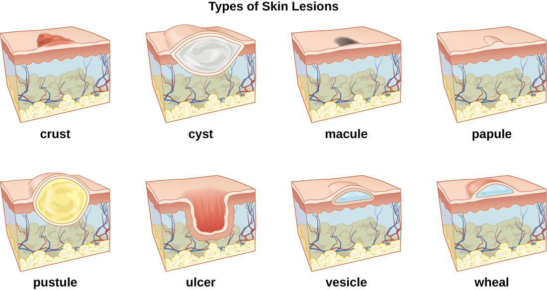 <p>Elevated, palpable, solid. Ex: Wart</p>