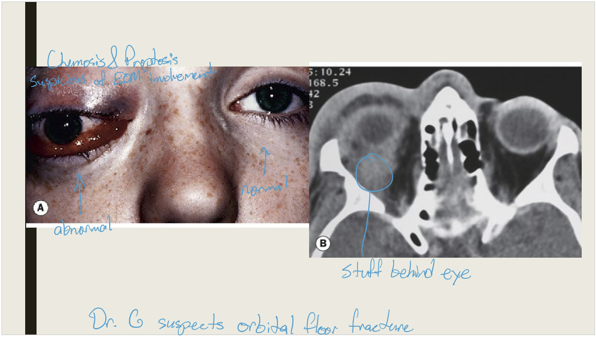 <ul><li><p>Extension of preseptal cellulitis </p></li><li><p>Sinus related (commonly ethmoidal)</p></li><li><p>Local spread (Dacryocystitis, mid-facial, or dental infection)</p></li><li><p>Post-trauma (onset 72 hours after injury)</p></li><li><p>Post-surgical complication </p></li></ul><p></p>