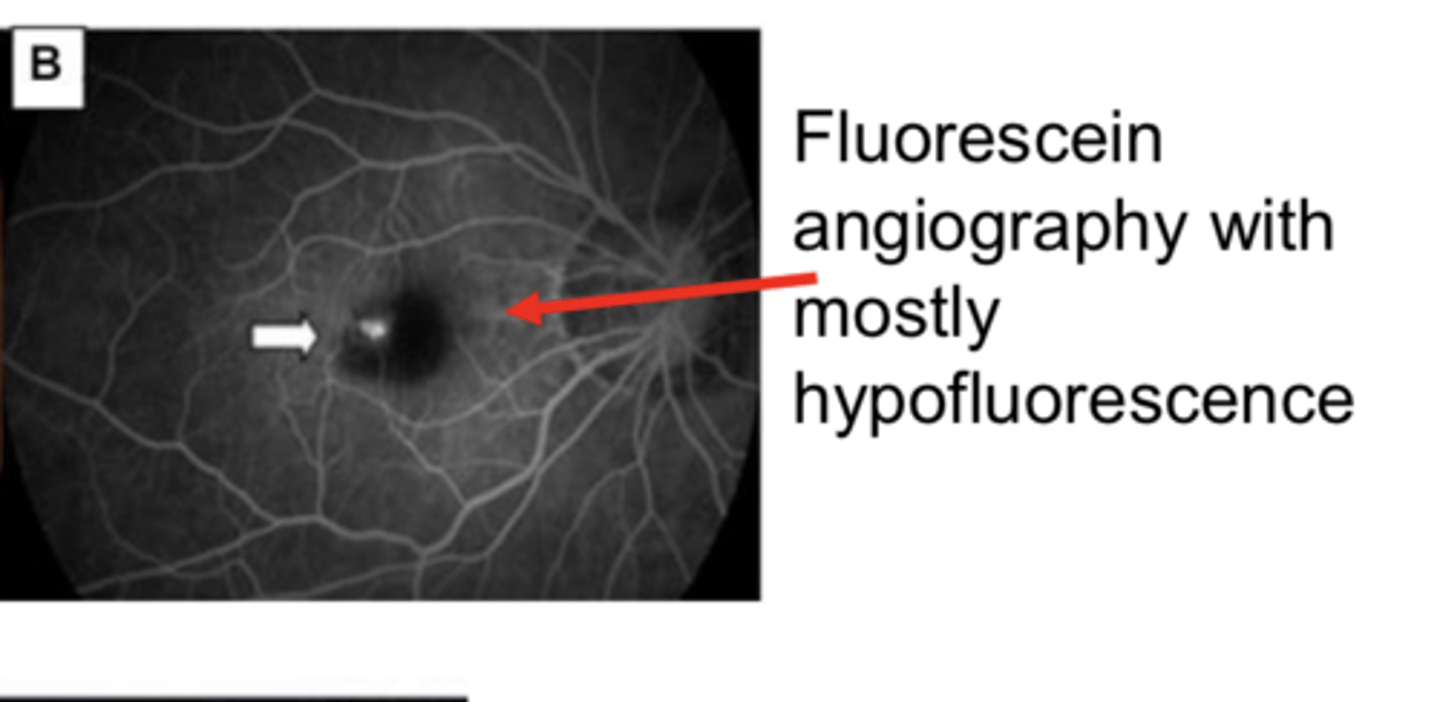 <p>Choroidal Neovascular Membrane with Hemorrhage in Pathological Myopia -- Fluorescein Angiography with Hypofluorescence (Pic)</p>