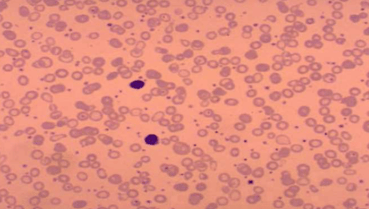 <p>-Hypochromic and microcytic cells</p><p>-most of the red cells are much smaller than the lymphocytes</p><p>-increased</p><p>platelet count</p>