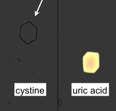 <p>Abnormal</p><ul><li><p>acid urine</p></li><li><p>Soluble in HCl, NaOH, NH4OH</p></li><li><p>No Polarization</p></li></ul><p></p>