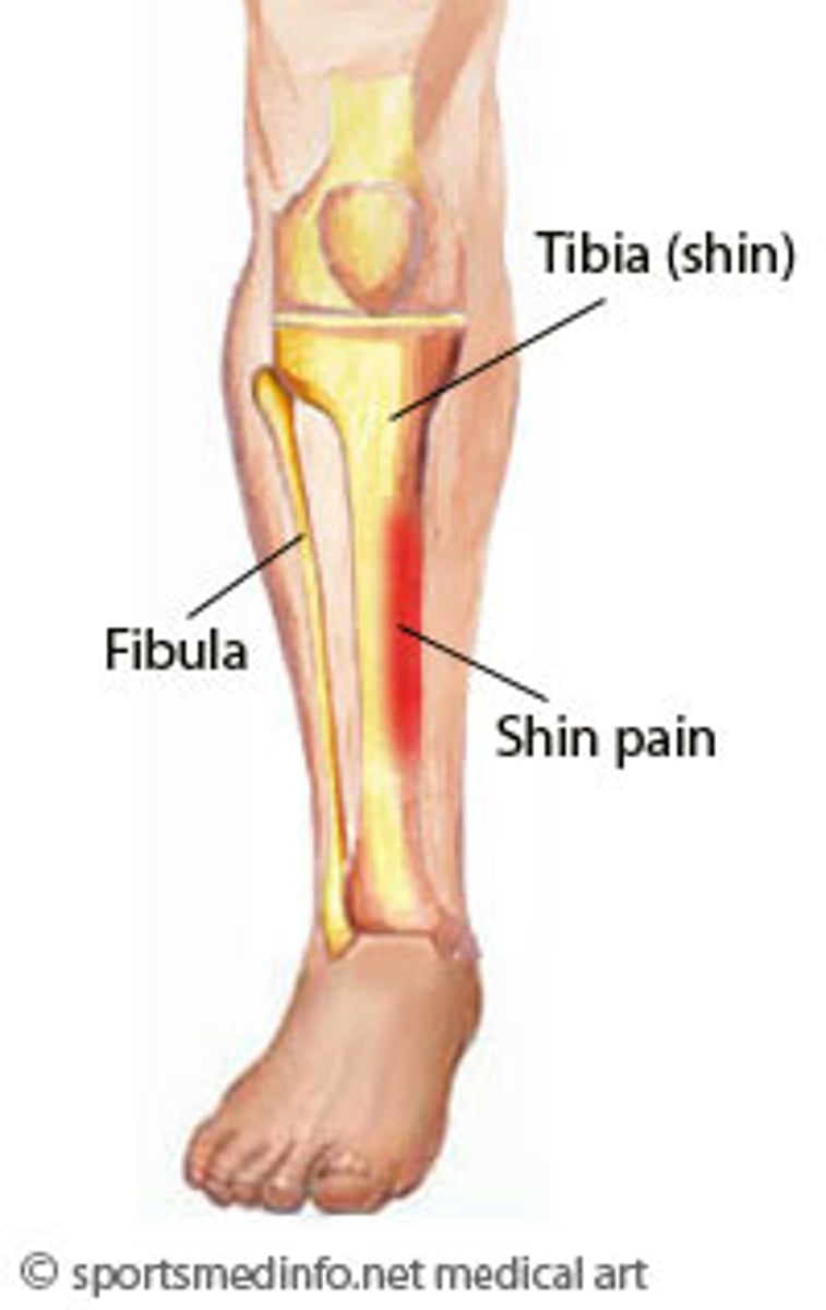 <p>- pain along the anterior aspect of the leg</p><p>- results from microtearing along the tibialis posterior attachment to the interosseus membrane from repetitive stresses</p><p>- presents with dull aching pain to front of the leg</p>