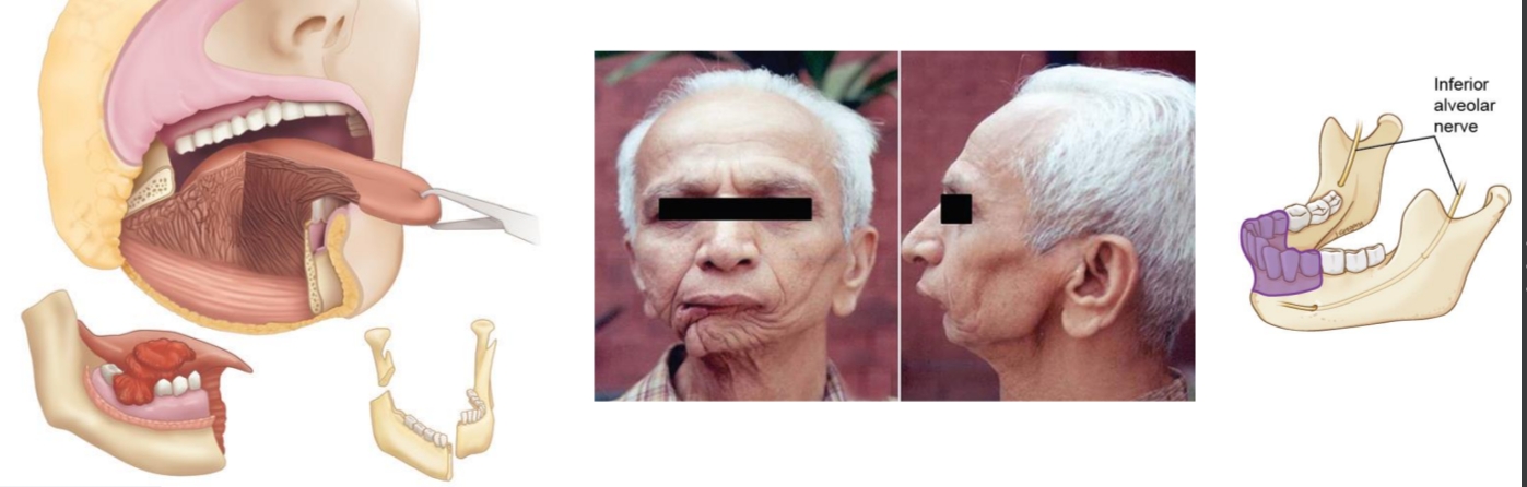 <p>Mondbodem, trigonum retromolare, gingiva onderkaak (T4)-</p><p>→ reconstructie vr functie te verkrijgen</p><p></p>