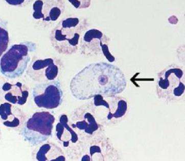 <p><strong>Identify parasite/stage, mention the examined sample, and name the disease induced by this parasite in the CNS.</strong></p><ul><li><p><em>Naegleria fowleri</em> trophozoite, CSF.</p></li><li><p>Causes <strong>Primary Amoebic Meningoencephalitis (PAME).</strong></p></li></ul><div data-type="horizontalRule"><hr></div><p><strong>Mention the culture media you can use to confirm the diagnosis.</strong></p><ul><li><p><strong>Non-nutrient agar (1.5%) enriched with <em>Escherichia coli</em>.</strong></p></li></ul><div data-type="horizontalRule"><hr></div><p><strong>Mention the stain used and two morphological characteristics of this stage.</strong></p><ul><li><p><strong>Wright–Giemsa stain.</strong></p></li><li><p>About <strong>10–15 µm</strong>, has a <strong>single nucleus with a large central karyosome</strong>, <strong>blunt pseudopodia</strong>, <strong>food vacuoles</strong>, and a <strong>contractile vacuole.</strong></p></li></ul><div data-type="horizontalRule"><hr></div><p><strong>Identify another sample that can be used to detect this stage.</strong></p><ul><li><p><strong>Brain tissue biopsy</strong></p></li></ul><p></p>
