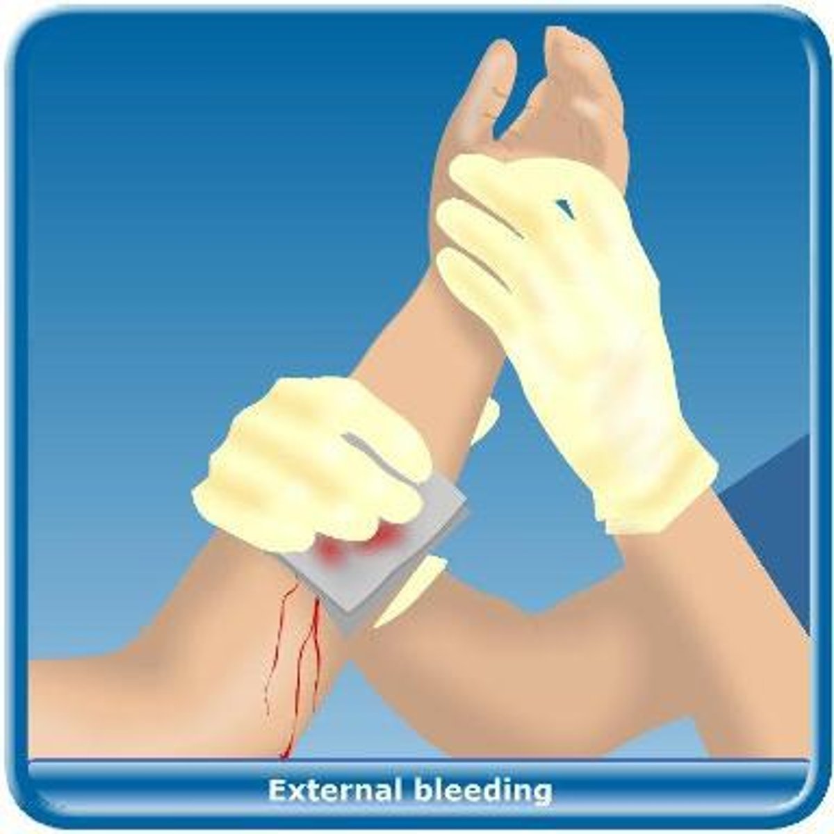 <p>1. wash hands, put on disposable gloves if available<br>2. place sterile or clean cloth on wound and apply direct pressure<br>3. Rinse wound with water and gently wash<br>4. Seek medical help if you can't remove dirt or debris from the wound. Apply antibacterial ointment<br>5. Cover wound with sterile dressing and bandage. Change dressing at least once a day, keeping wound clean and dry. Seek medical help if wound becomes infected--tender, swollen and red</p>