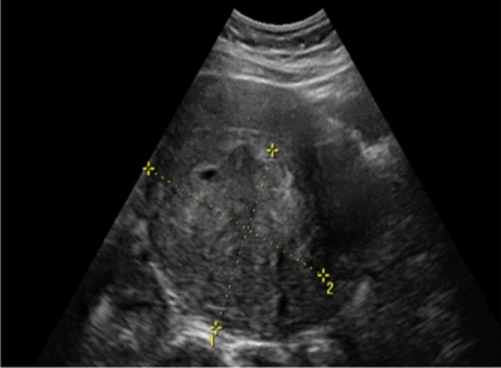 <p>Pre-existing ______ are common in those with leiomyosarcoma </p>