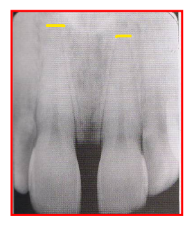 <ul><li><p>Teeth appear long and distorted </p><ul><li><p>Reason: insufficient vertical angulation (too flat) </p></li></ul></li><li><p>Fix: Tilt PID up or down to increase vertical angulation </p></li></ul><p></p>