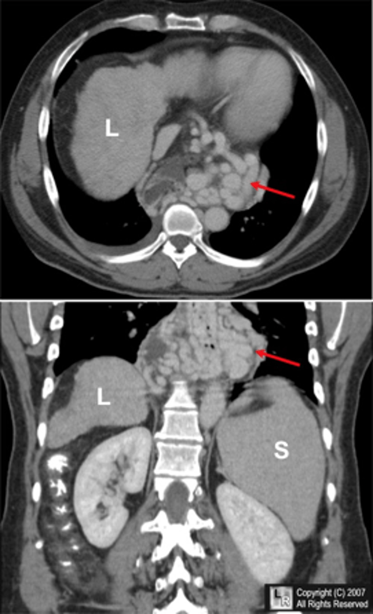 <p>Esophageal Varices</p>