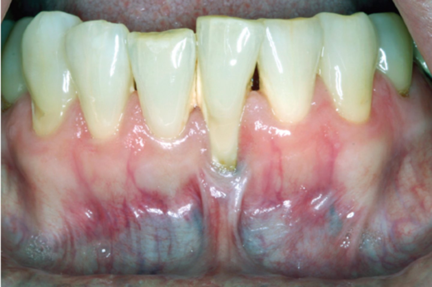 <p>What is this recession caused by and what are some treatment methods for this pt?</p><p>• caused by: ________</p><p>• treatment:</p><p>• f______</p><p>• t_____ g_____</p><p>• p__ e___</p><p>• product recommendations: e____ s____ TB, s______ TB technique</p>