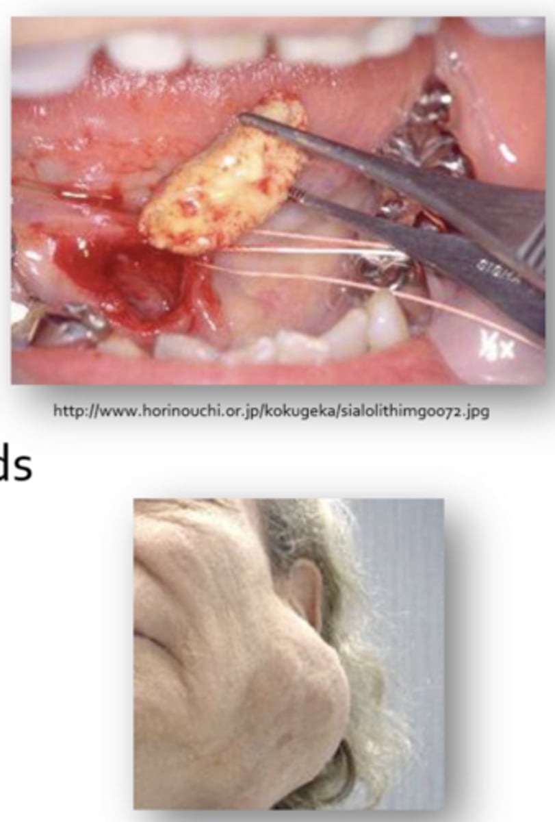 <p>sialoliths</p><p>mucus</p><p>trauma</p><p>tumors</p>
