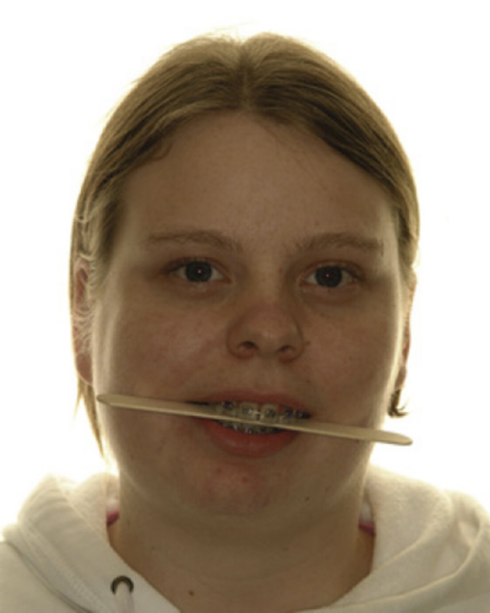 <p>mandible condyle during childhood</p><p>= can cause asymmetry</p><p>PHOTO = curve of Wilson</p>