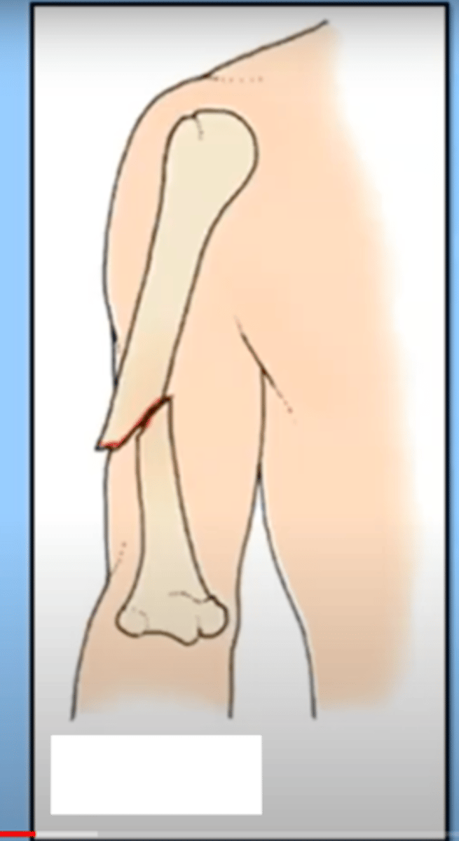 <p>broken bone penetrates through the skin</p><p>major consideration to the complexity and healing process/risk to the patient</p><p>big infection risk</p>