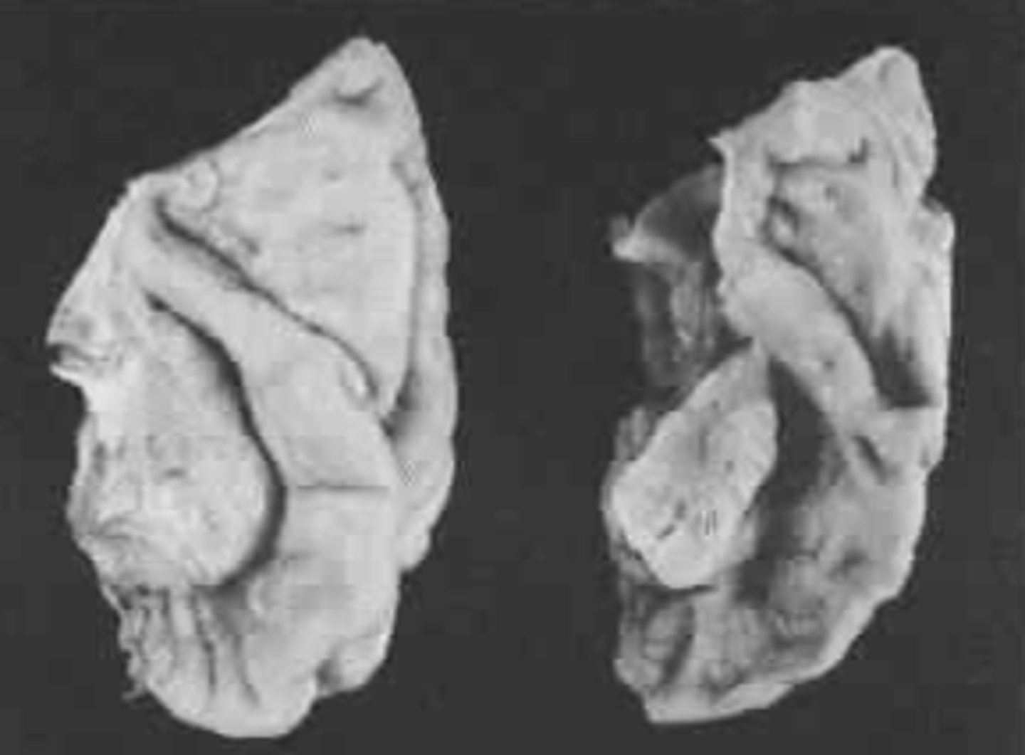 <p>- Can't interpret words</p><p>- Misses some words</p><p>- Gets off target or topic</p>